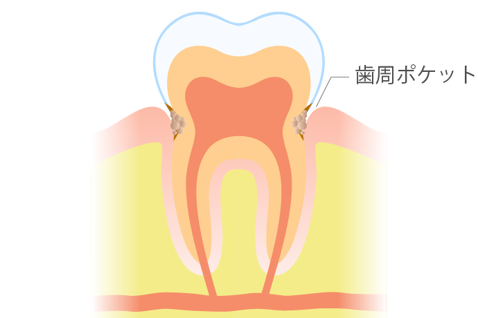 歯周病ステージ1