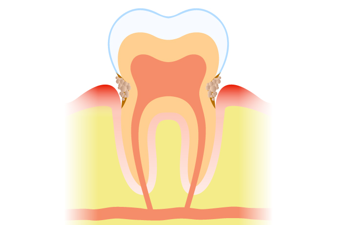 歯周病ステージ2