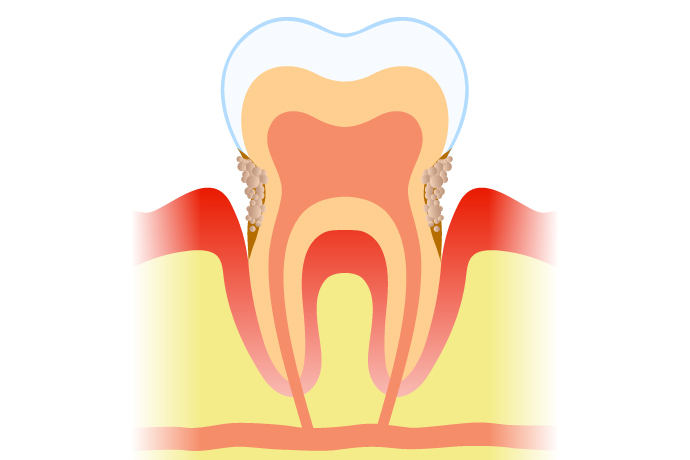 歯周病ステージ3