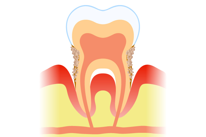 歯周病ステージ4